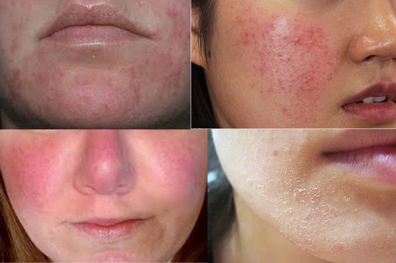 cách xử lý tác dụng phụ khi sử dụng retinol