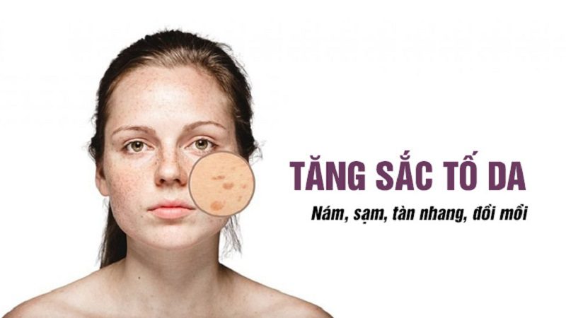 Tăng sắc tố da – Nguyên nhân gây nám và các mảng tối trên da