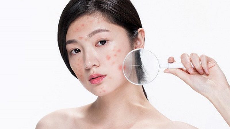 dấu hiệu nhận biết mụn thâm