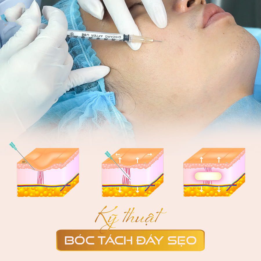 Vì sao cần bóc tách đáy sẹo?