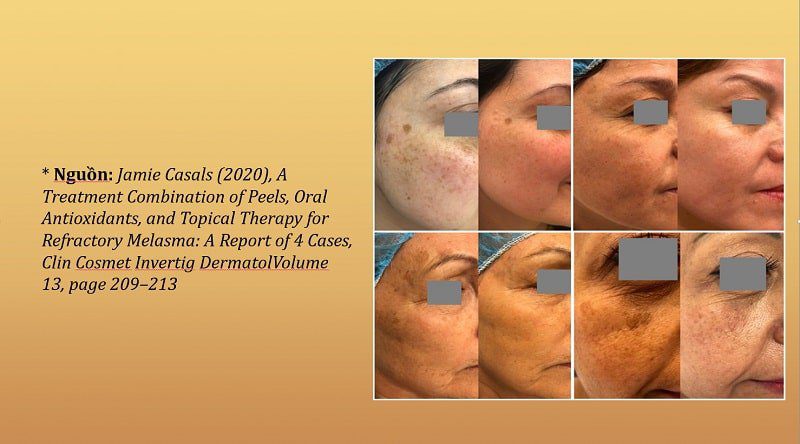 Niacinamide + Resorcinol trong điều trị sắc tố