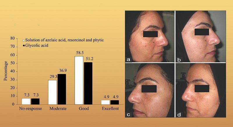 Resorcinol tác dụng trị nám
