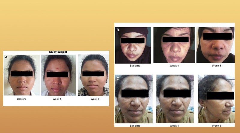 retinol 0,5% + Niacinamide+ 1,1% Hexylresorcinol có hiệu quả để làm sáng da