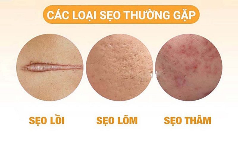sẹo mụn thường gặp