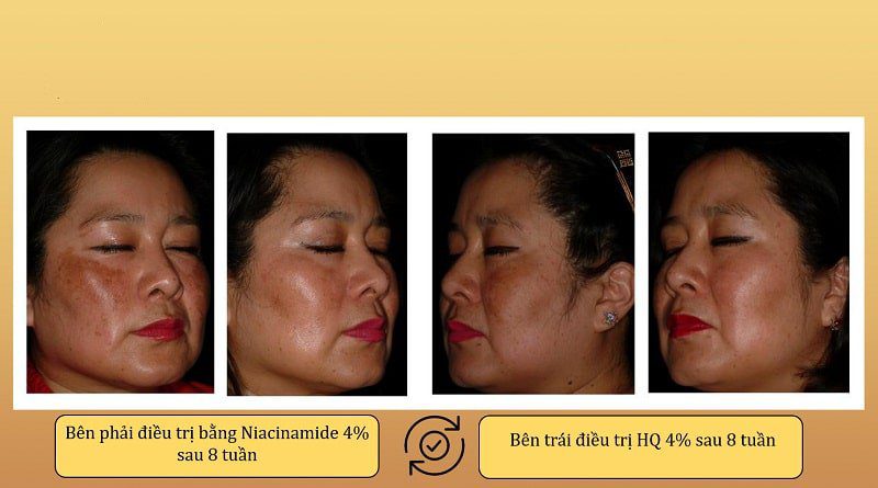 So sánh hiệu quả trị nám Niacinamide và Hydroquione - 2