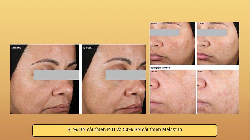 Kết hợp Niacinamide + TRX 2