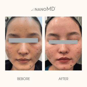 hiệu quả điều trị nanomd cyntra