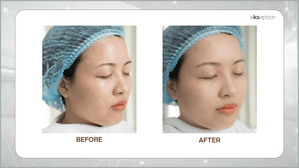 trước và sau khi điều trị với white up peptide peel