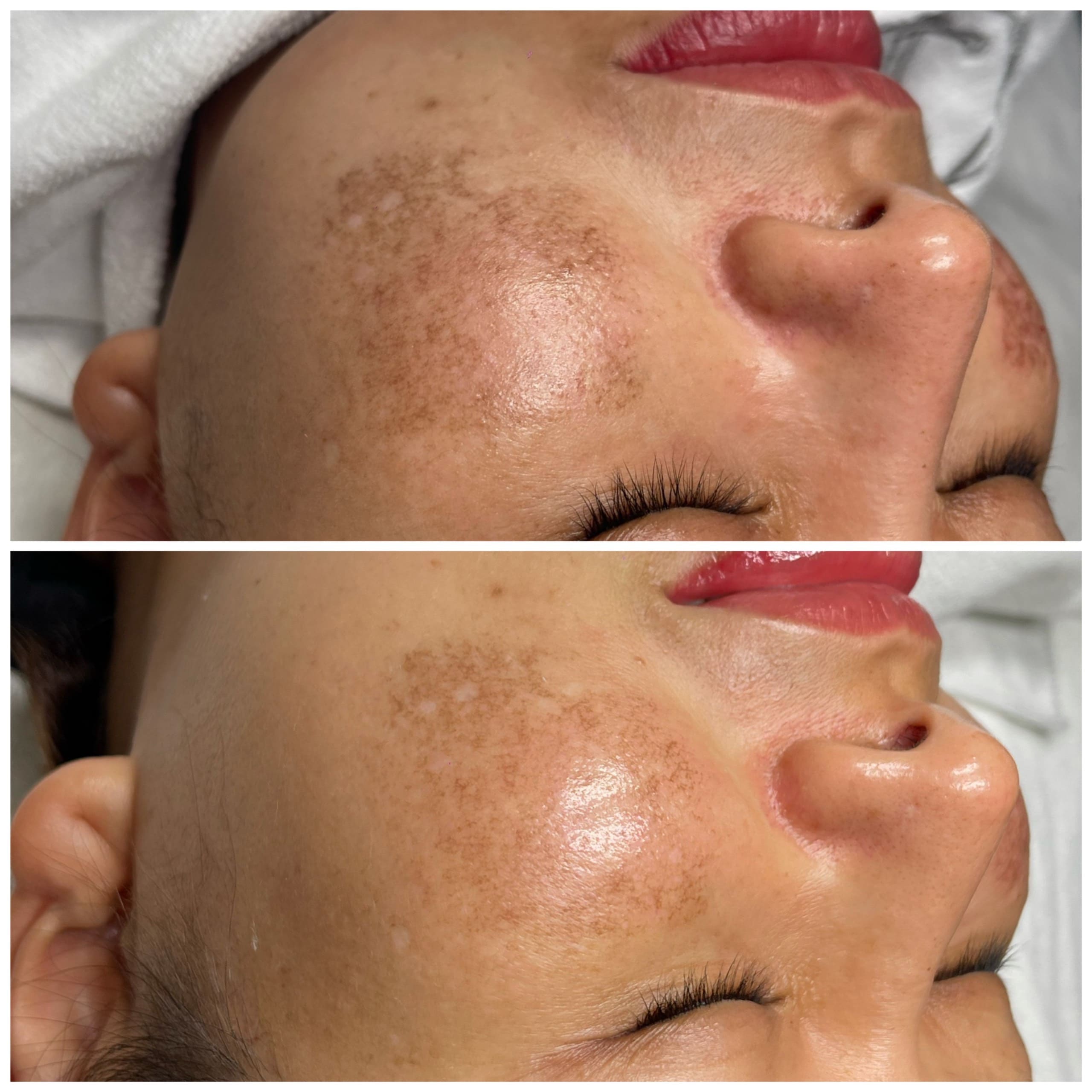 Case lâm sàng sau 2 tuần điều trị nám với meso và kem bôi chứa Cysteamine 7.5% và Tranexamic Acid 3% (sản phẩm NanoMD CYNTRA)