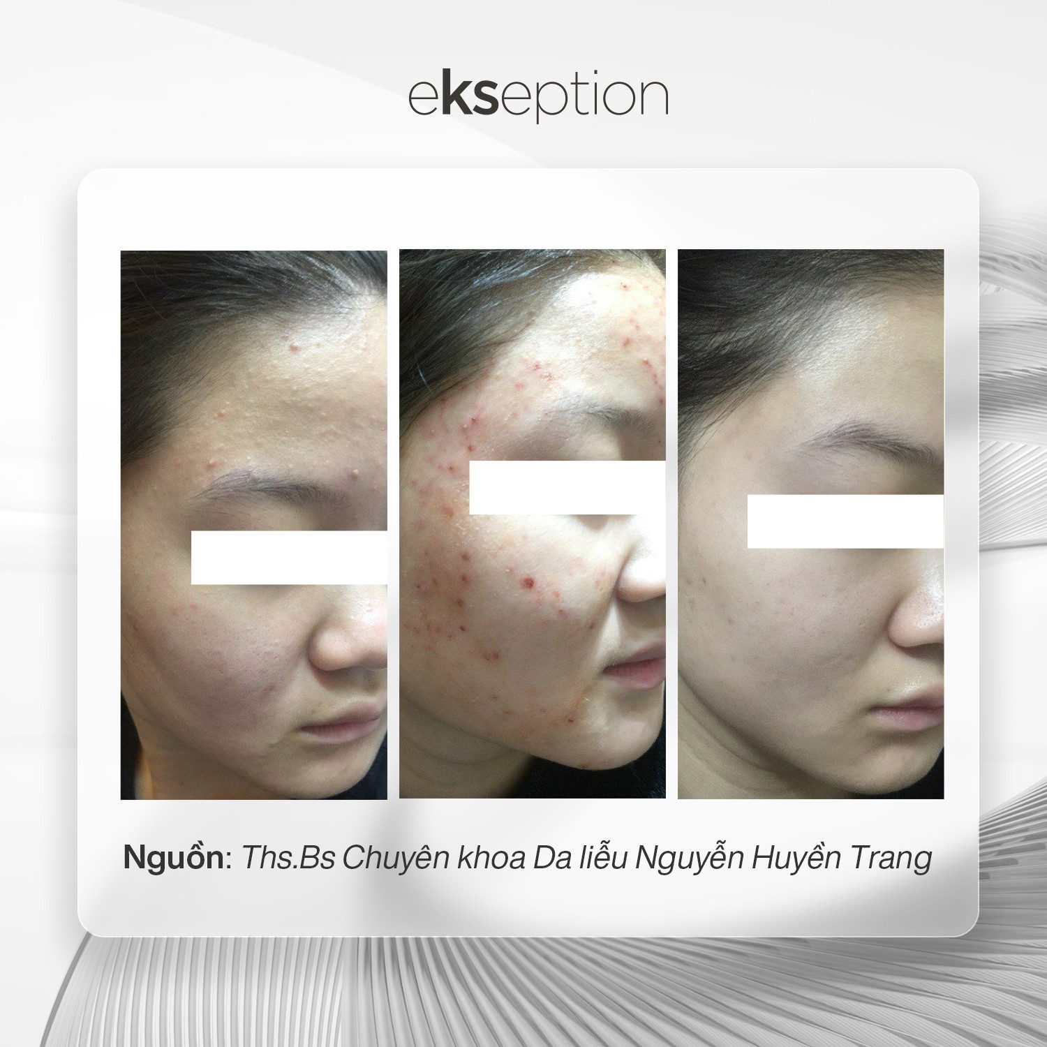 Phức hợp xử lý mụn độc quyền: Zn, Niacin, Trx