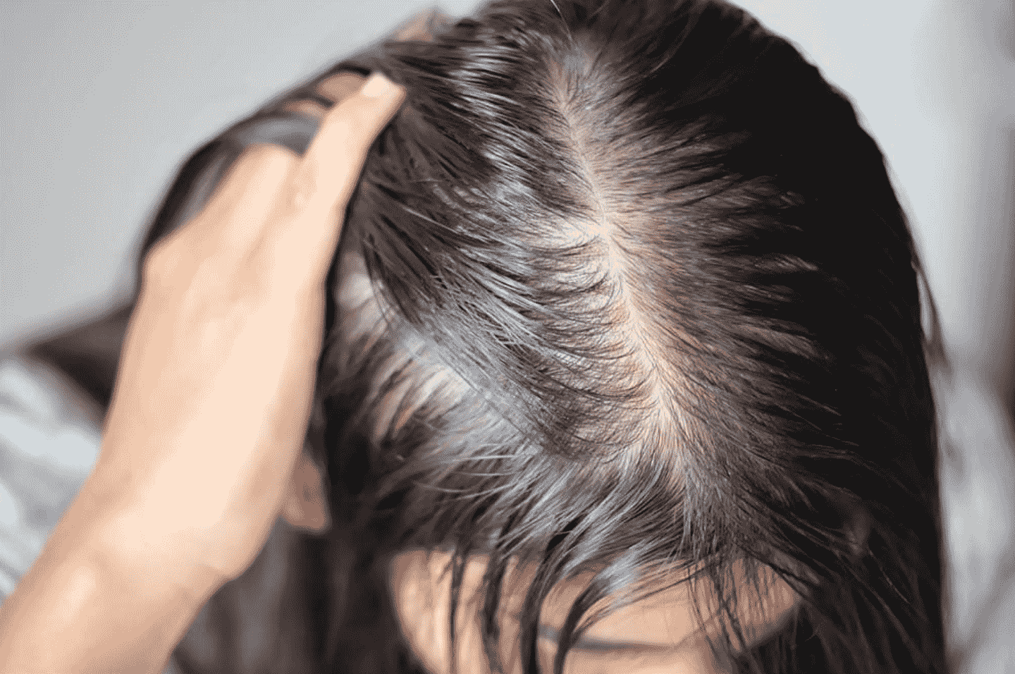 Các phương pháp điều trị rụng tóc tốt nhất hiện nay
