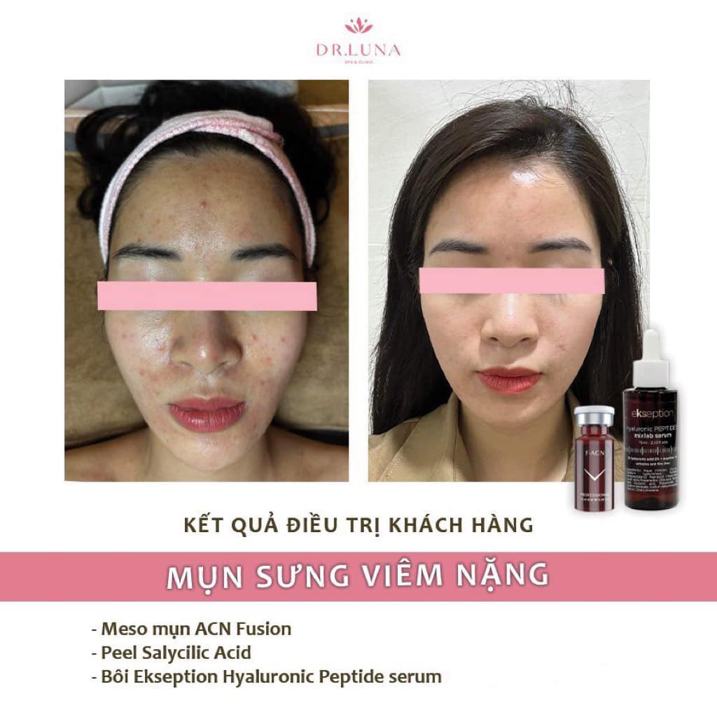 Showcase ứng dụng F-ACN & F-Mesomatrix